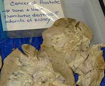Carcinoma Prostate